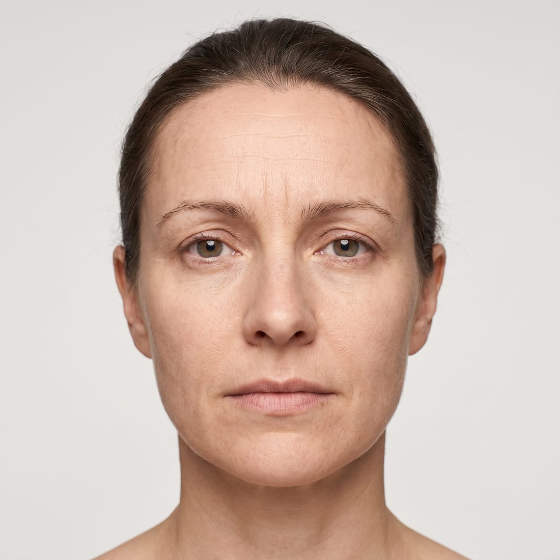 Forehead before anti-wrinkle treatment