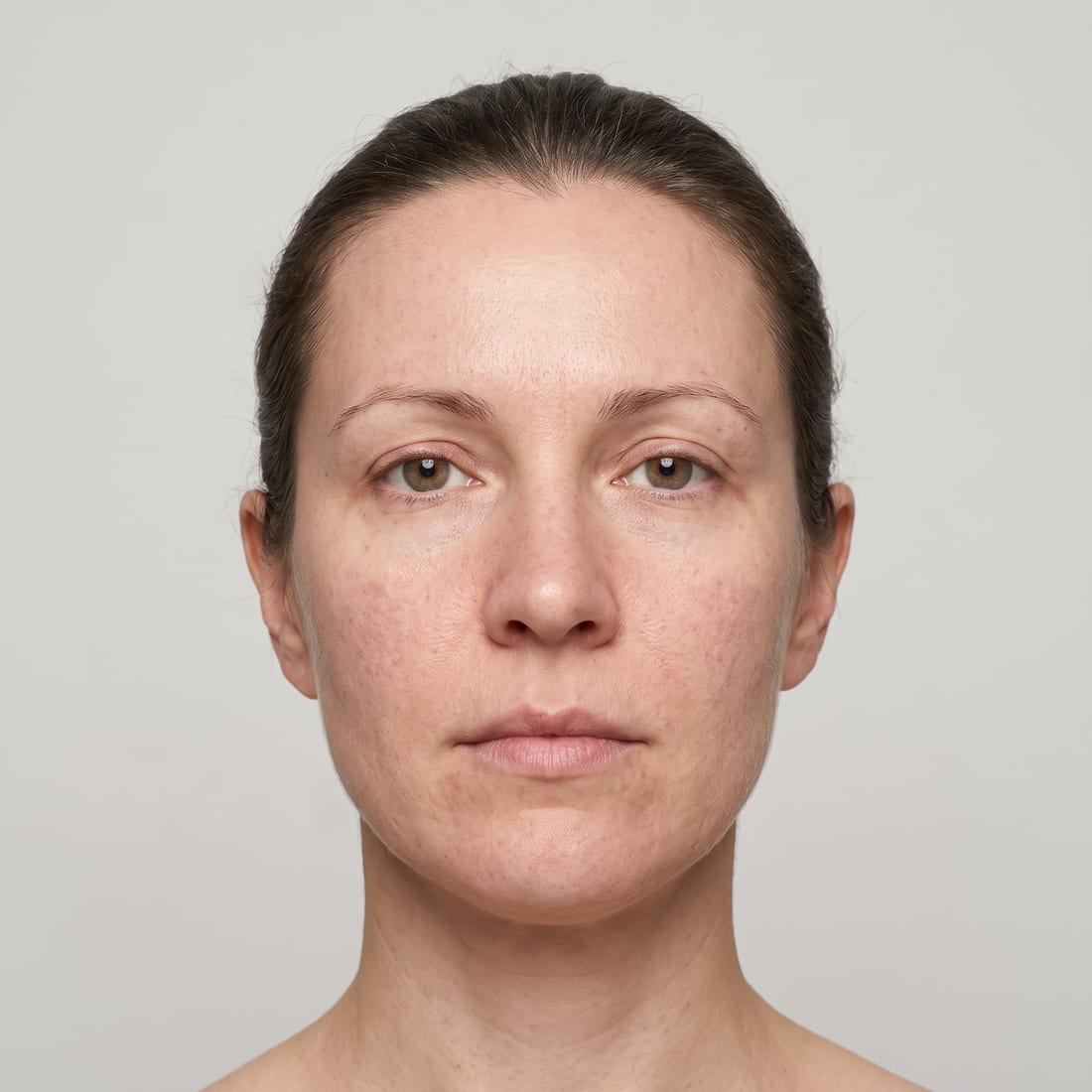 Skin before treatment course